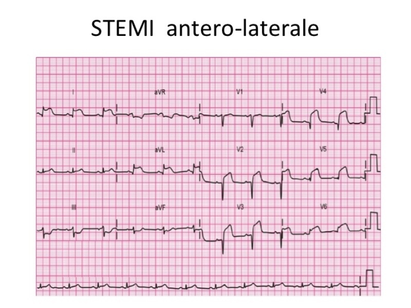 STEMI Antero Laterale