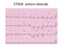 Capitolo 1 - STEMI Antero Laterale