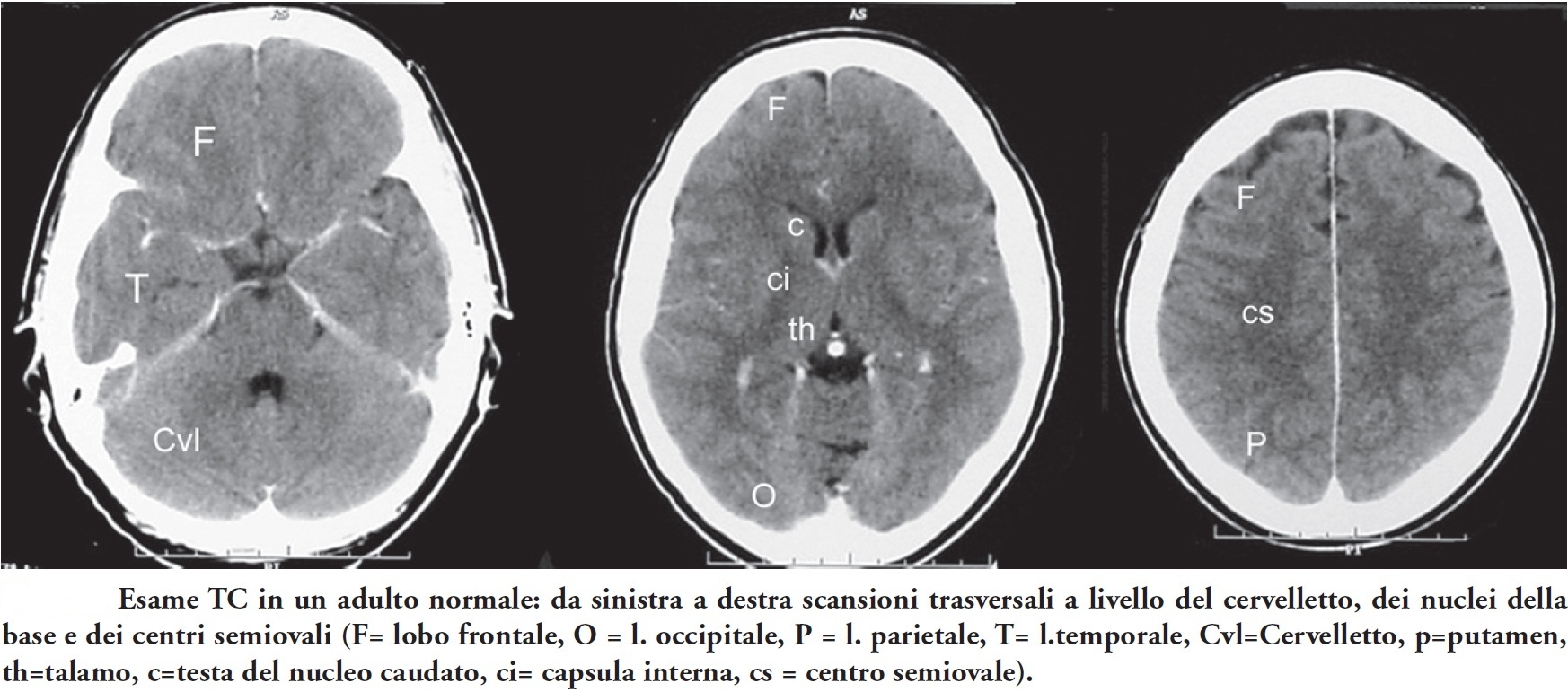 TC Cranio Normale
