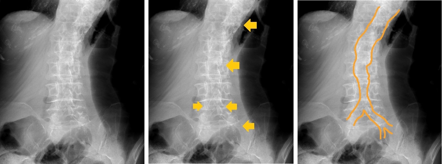 Calcificazione del distretto aorto-iliaco