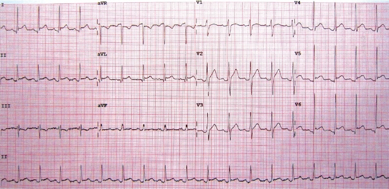 ECG pericardite acuta