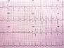 Capitolo 2 - ECG in pericardite acuta