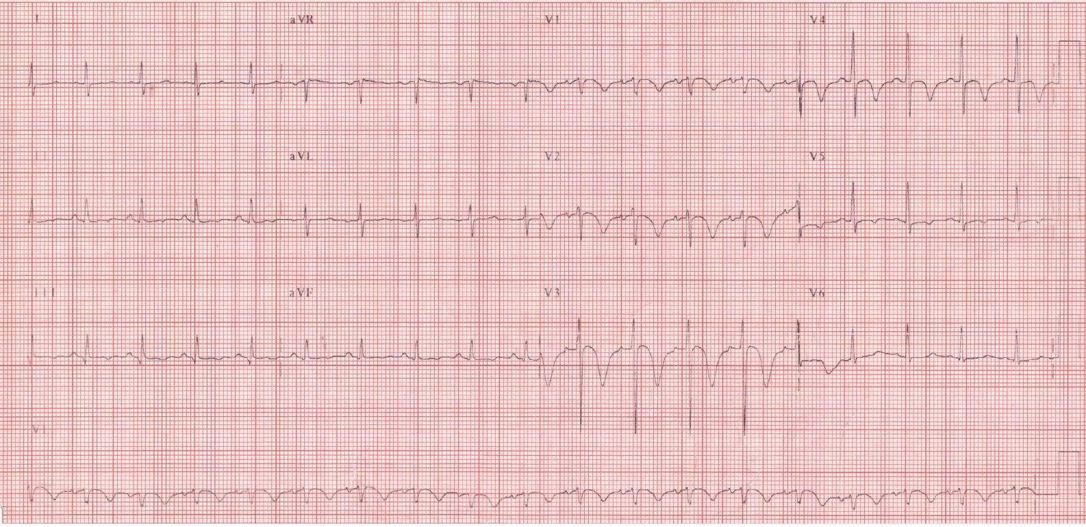 ECG in TEP 1