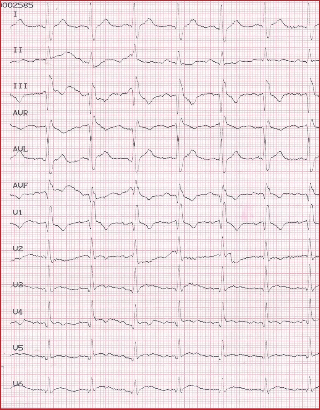 ECG in TEP 2