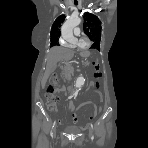 Immagine TC dissezione aorta 2
