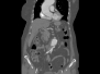 Capitolo 2 - Immagine TC dissezione aorta 2