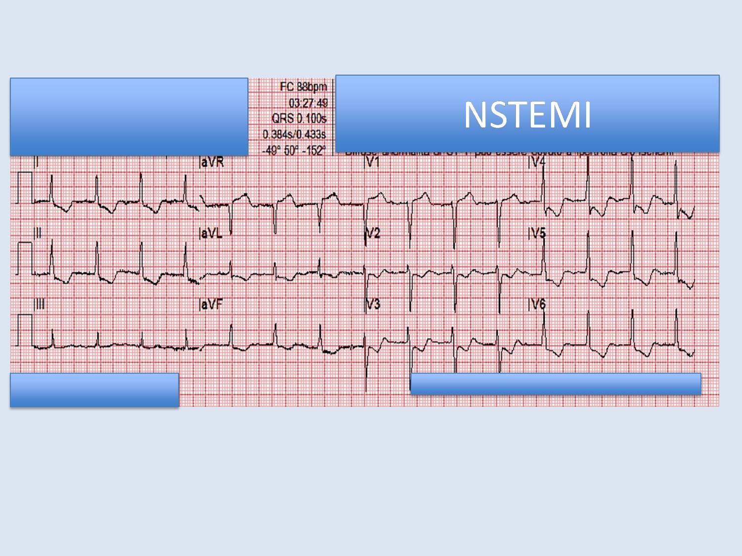 NSTEMI