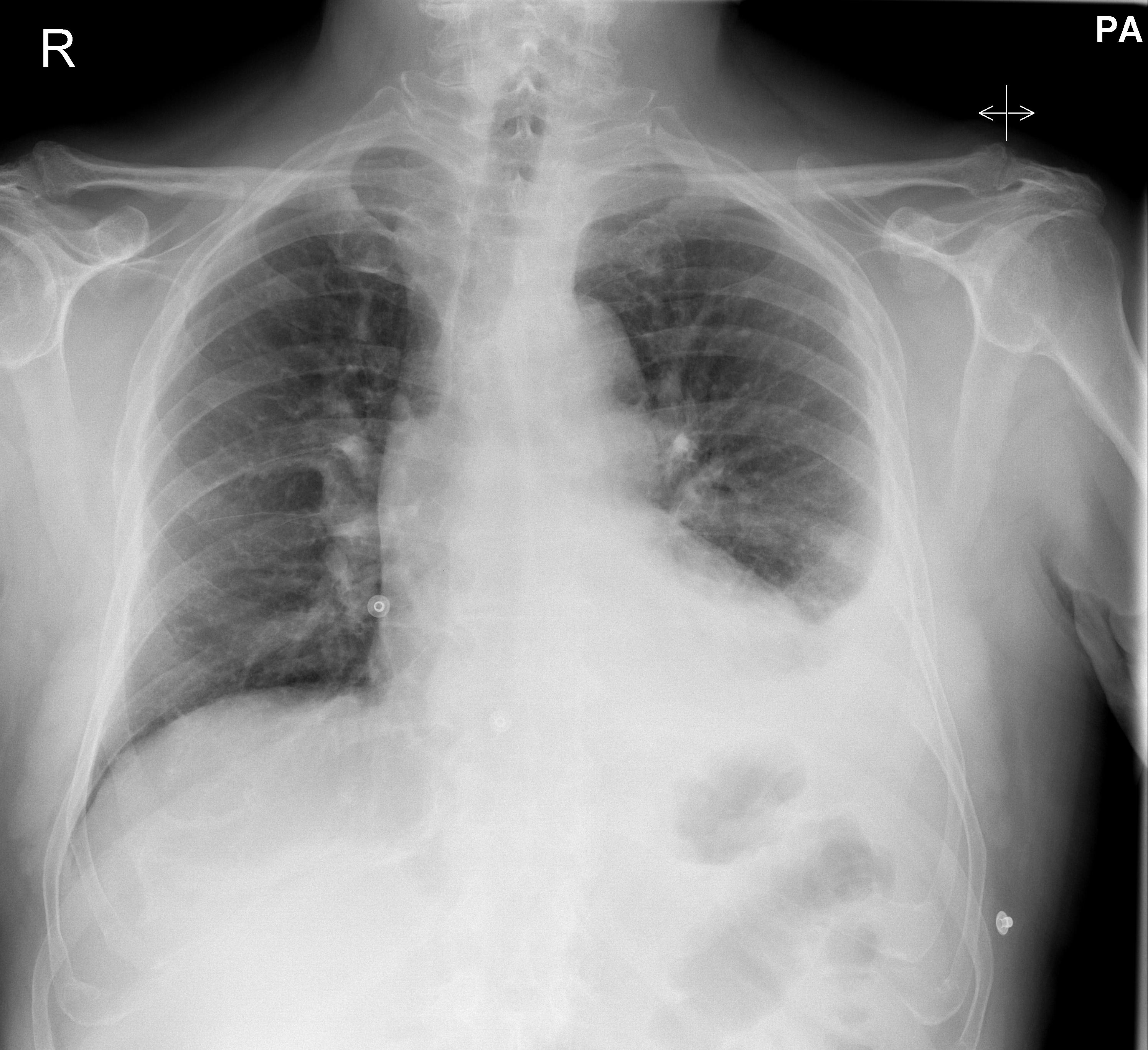 RX in pericardite 1