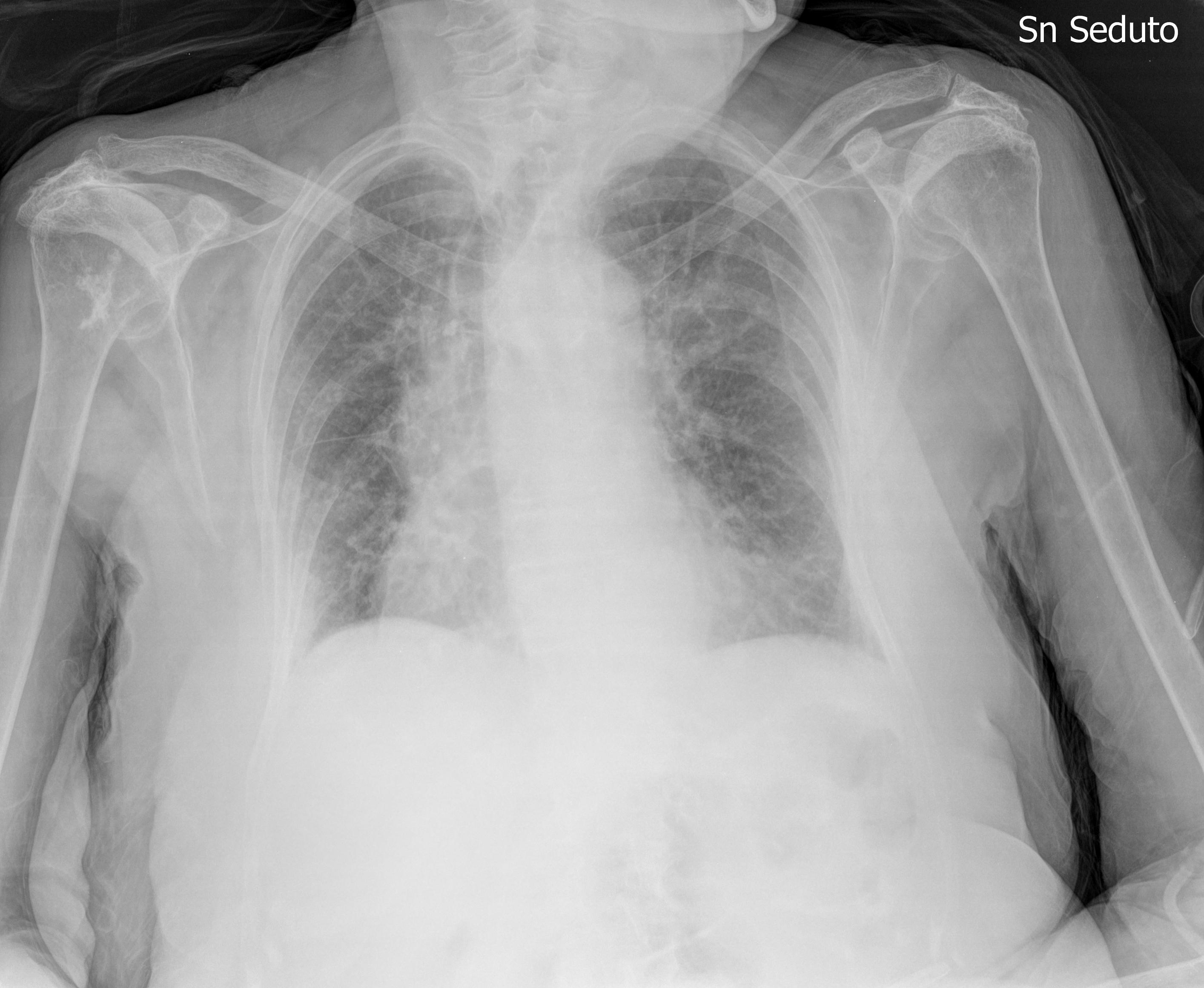 RX in pericardite 2