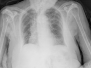 Capitolo 2 - RX in pericardite 2