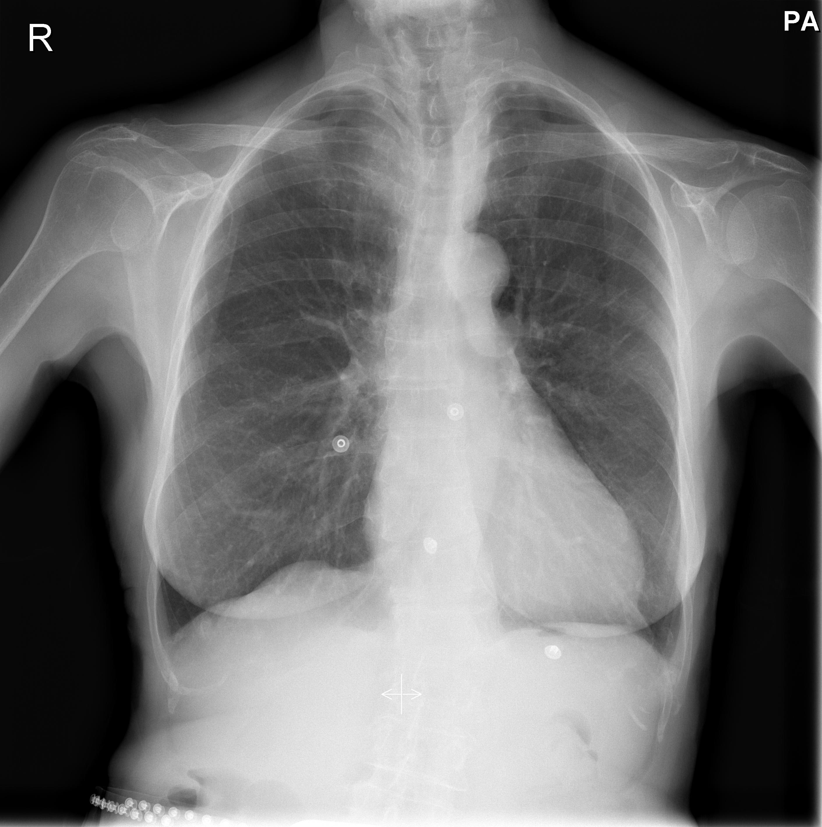 RX in pericardite 3
