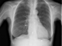 Capitolo 2 - RX in pericardite 3