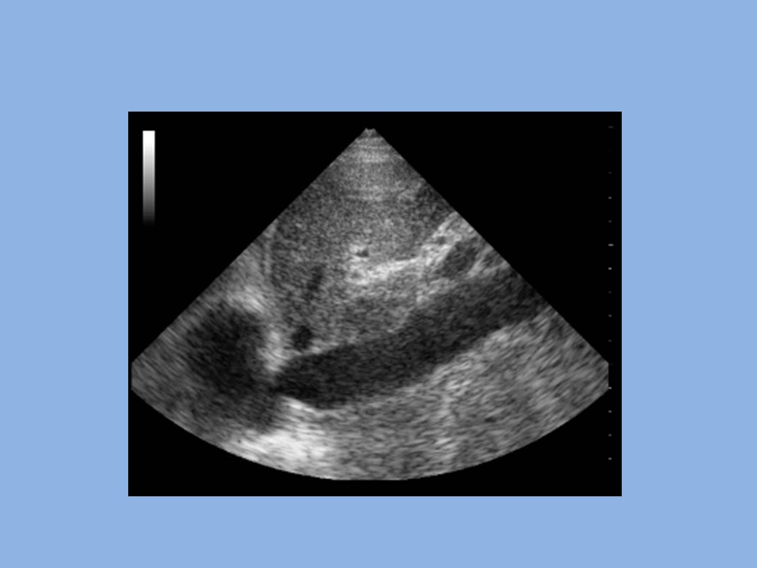 Vena cava fissa