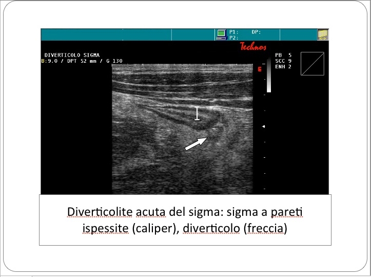 ECO Diverticolite acuta