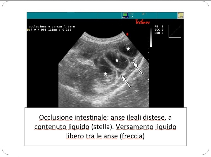 ECO occlusione intestinale