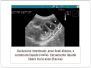 Capitolo 4 - ECO Occlusione intestinale
