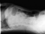 Capitolo 4 - RX Perforazione - Rx L-L in paziente con decubito obbligato. Piccola falda aerea sottodiaframmatica di non facile identificazione
