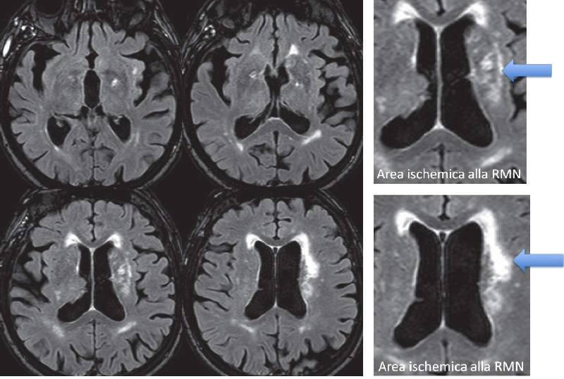 RMN Ischemia Cerebrale 1
