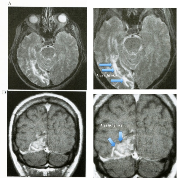 RMN Ischemia Cerebrale 2