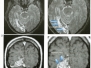 Capitolo 5 - RMN Ischemia Cerebrale 2